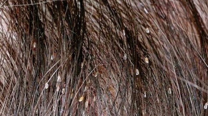 hair lice