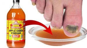 apple cider vinegar for fungus